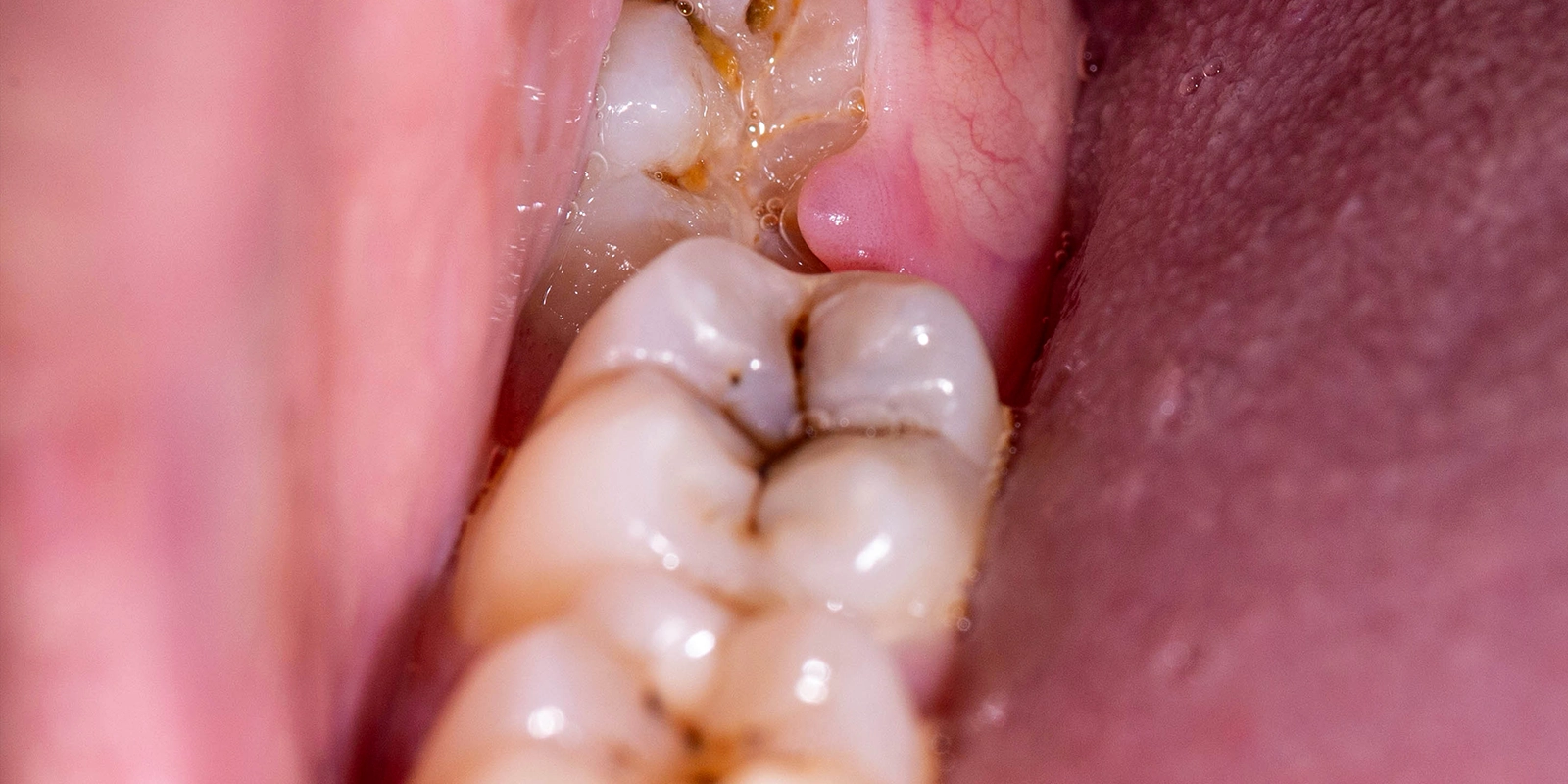 虫歯ができる原因