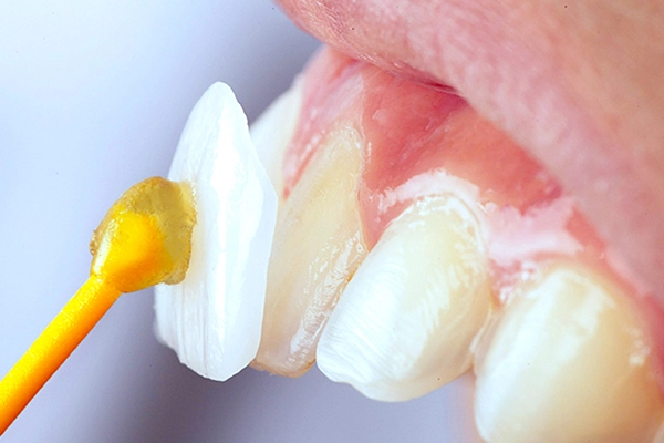 ラミネートベニア