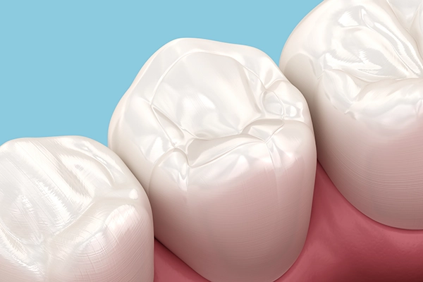 コンポジットレジン治療