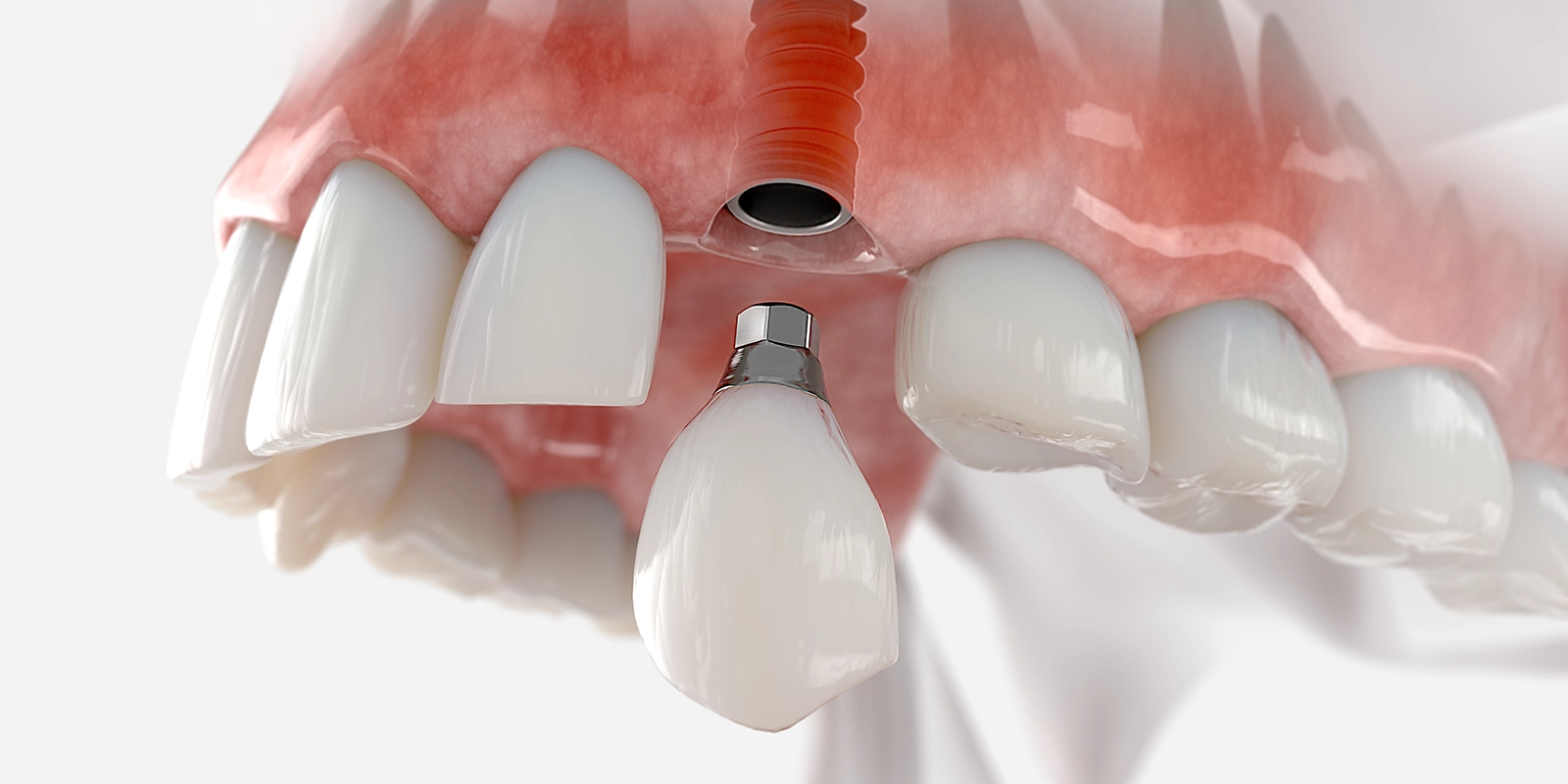 インプラント治療とは