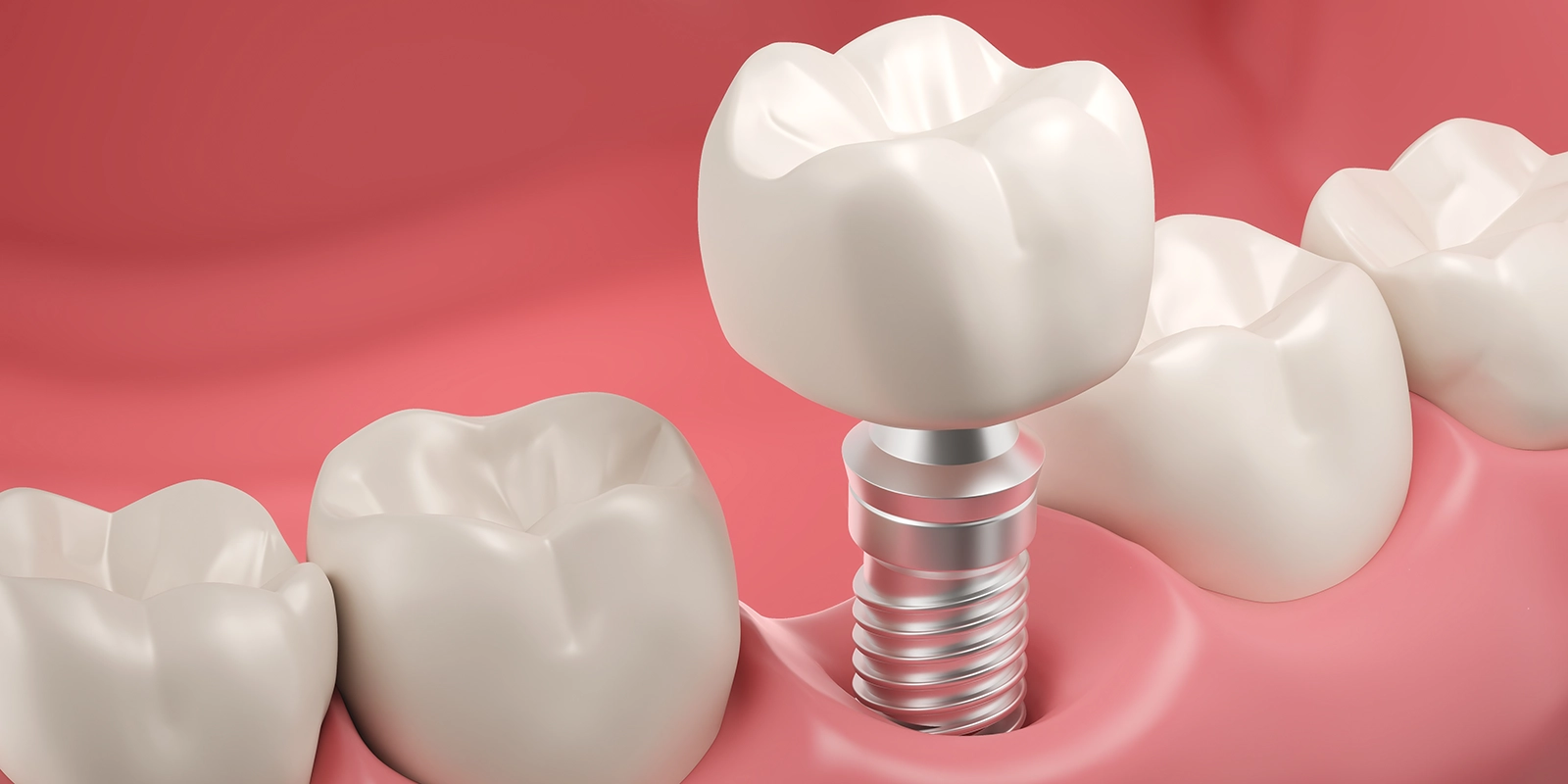 当院のインプラント治療の特徴