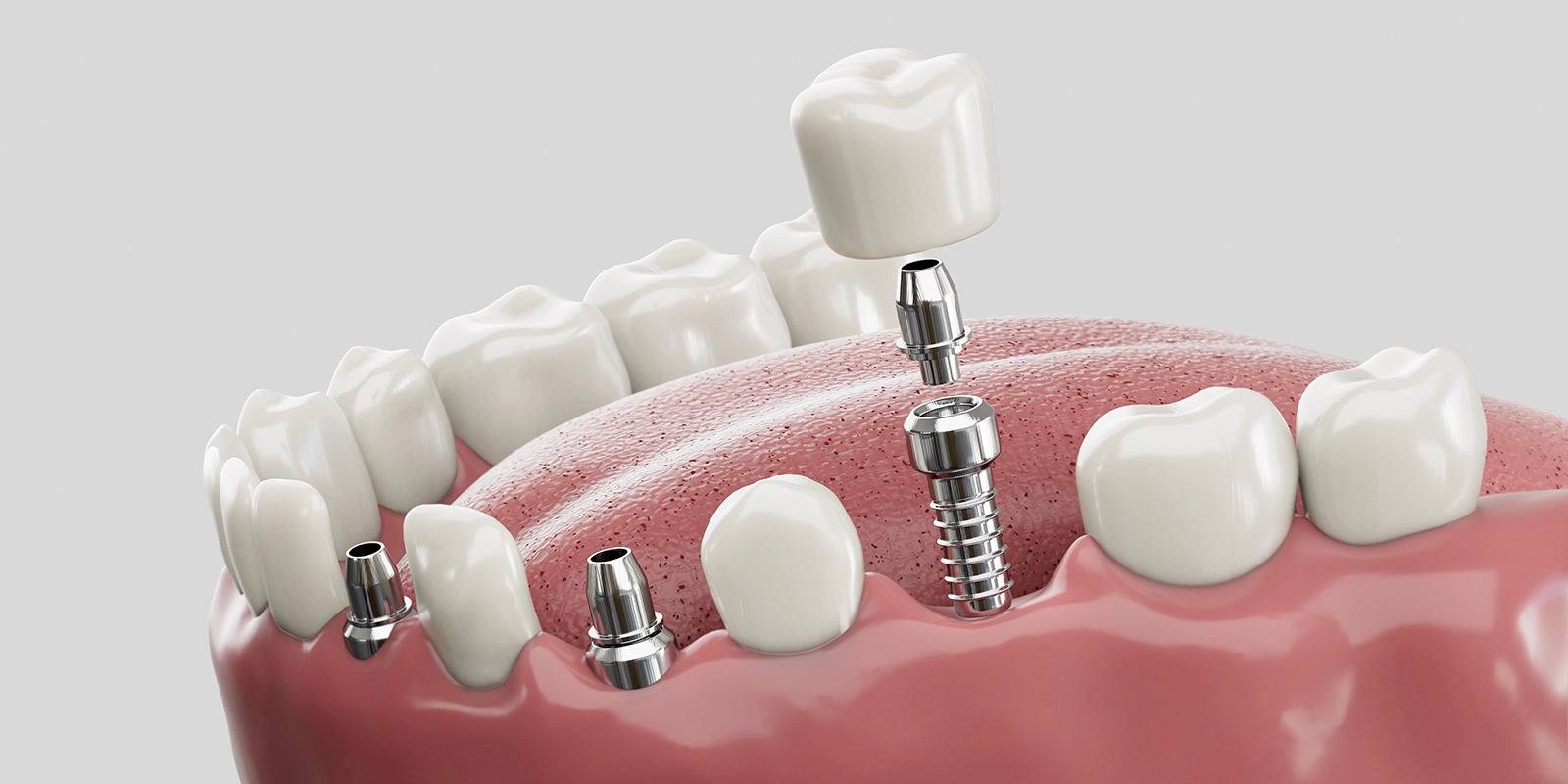 インプラント治療の流れ