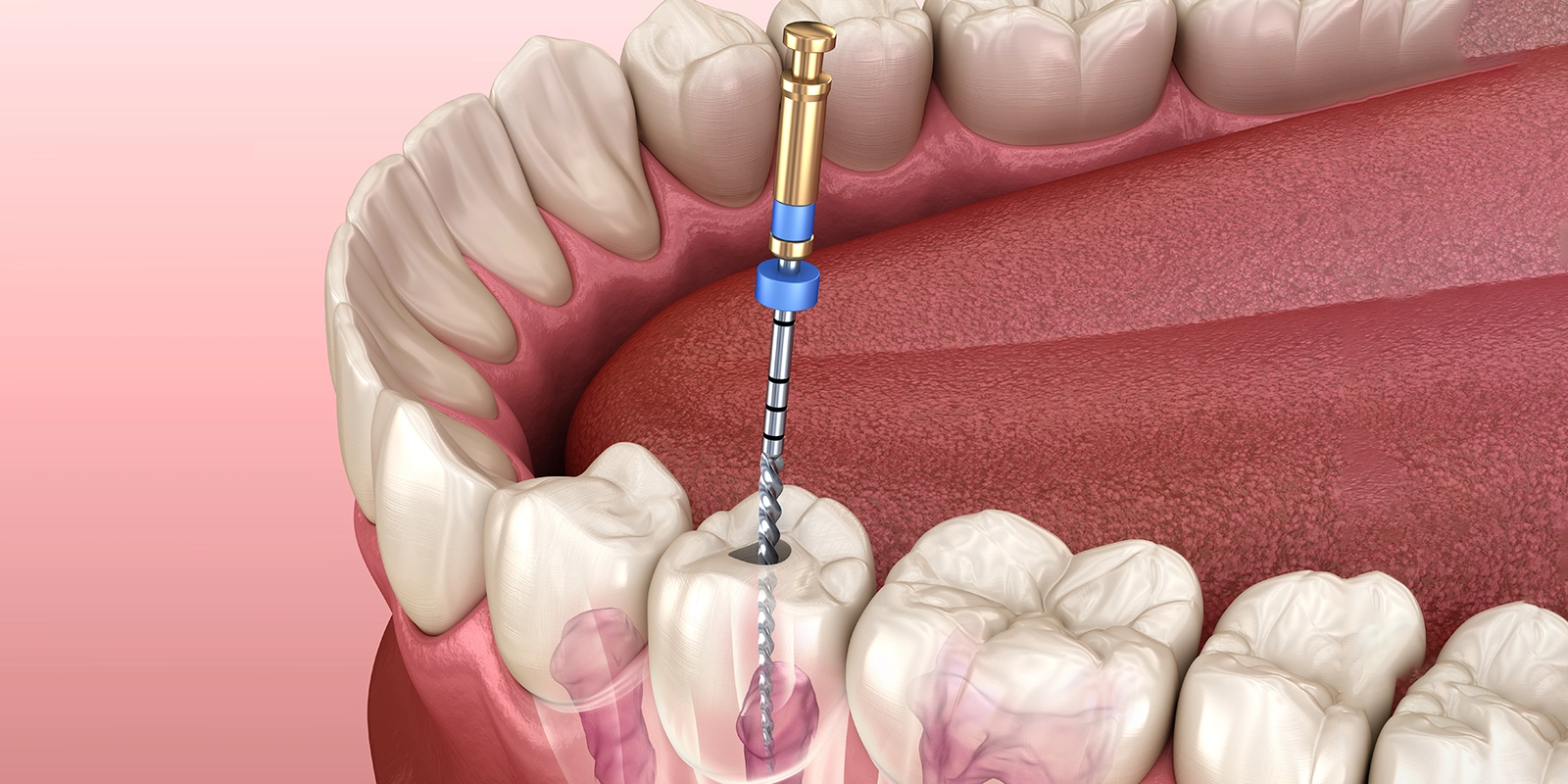 根管治療について