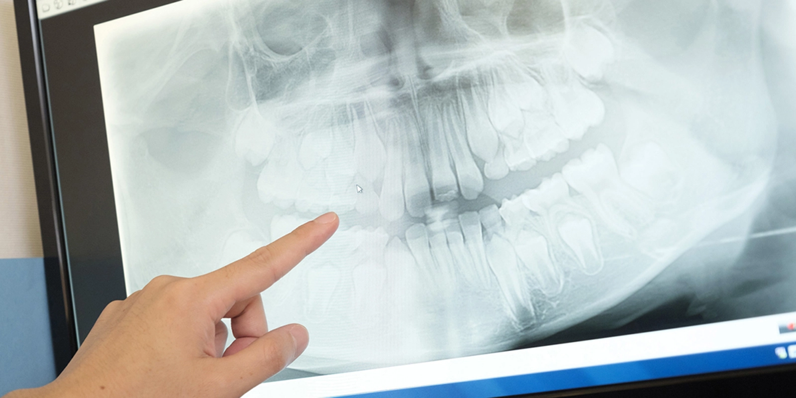 当院の根管治療の特徴