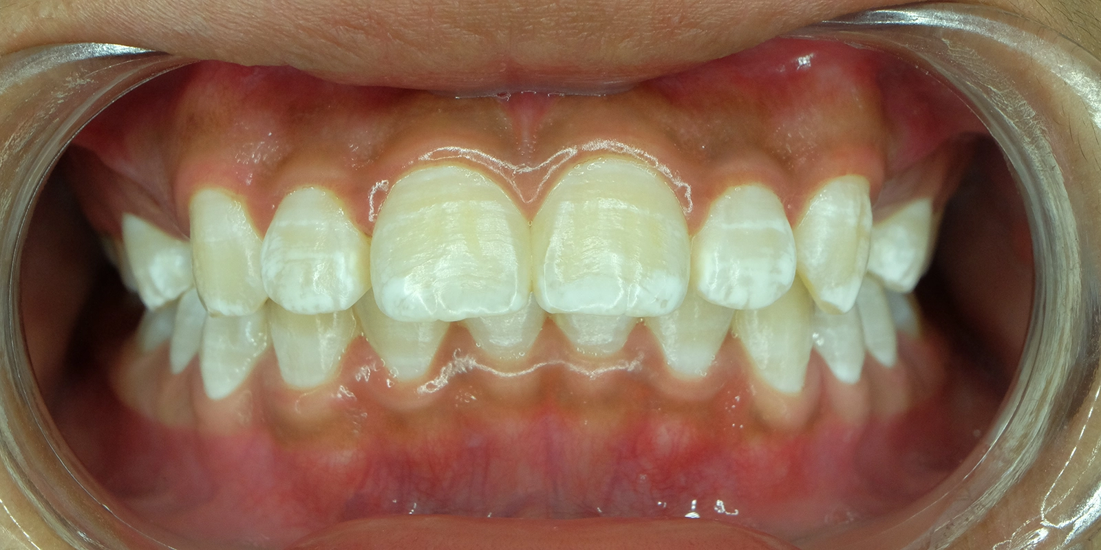 ホワイトスポットとは