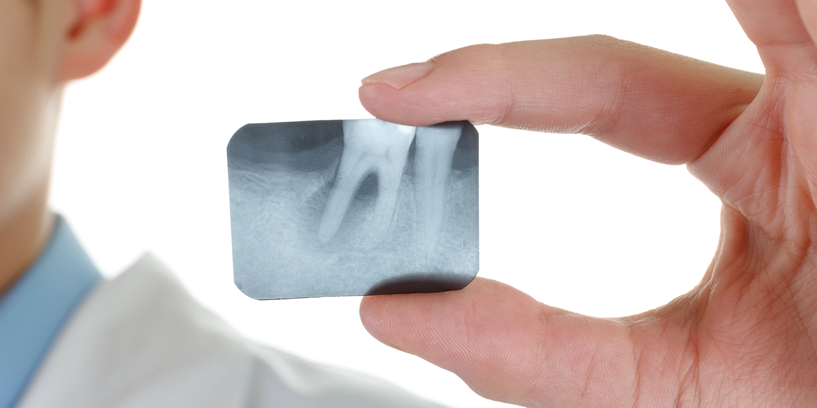 抜歯後の注意事項