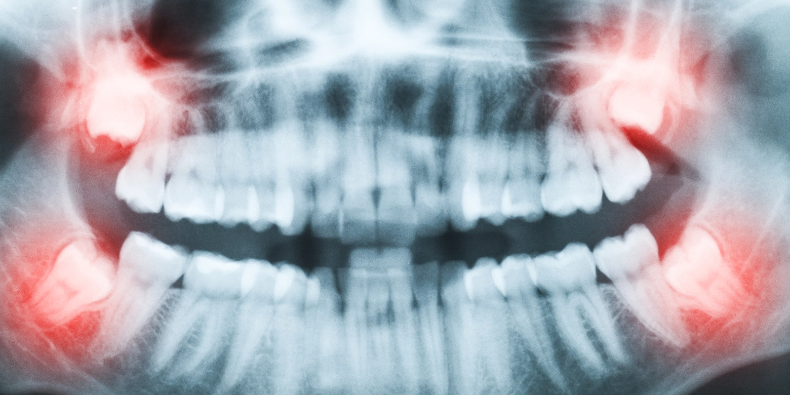 親知らずを抜歯する必要がある場合